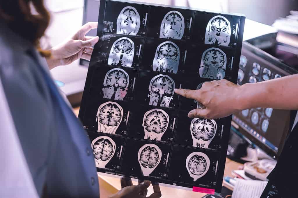 Atrofi Otak: Penyebab, Gejala, dan Pengobatan