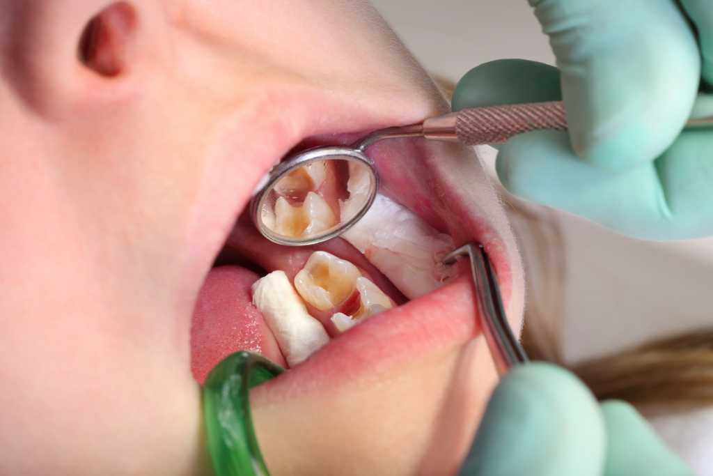 8 Bahaya Gigi Berlubang (Nyawa Taruhannya!)