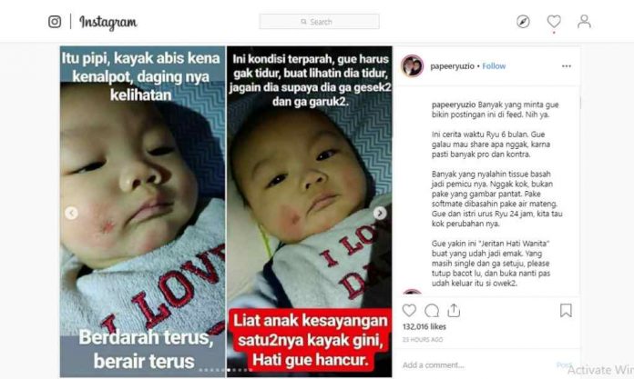 dermatitis-atopik-kulit-bayi-doktersehat