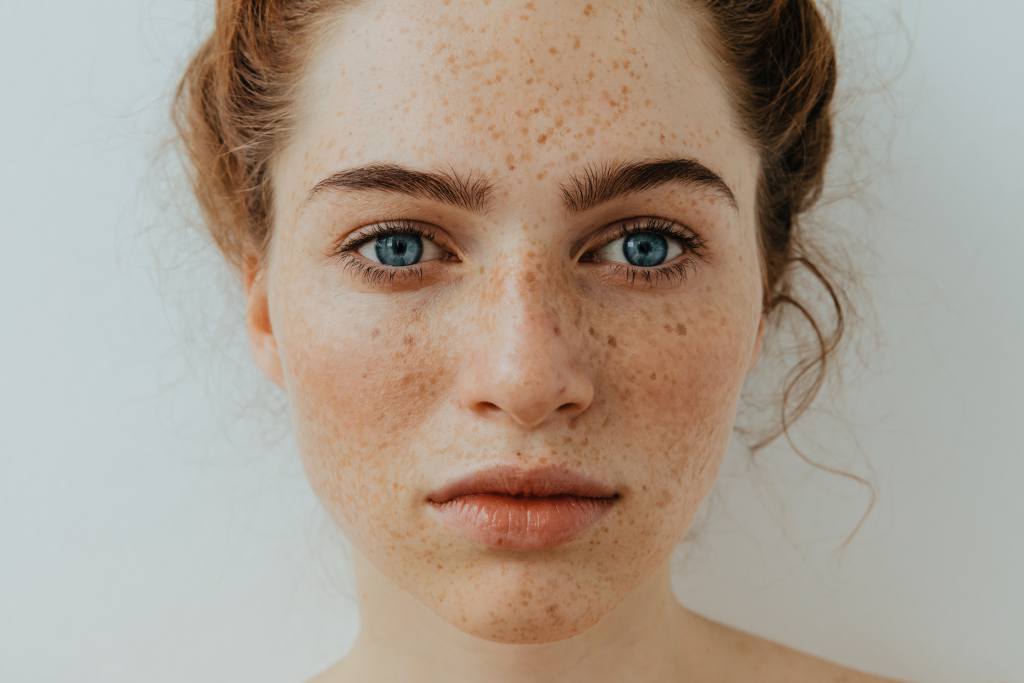 Freckles: Penyebab, Jenis, Cara Mengatasi