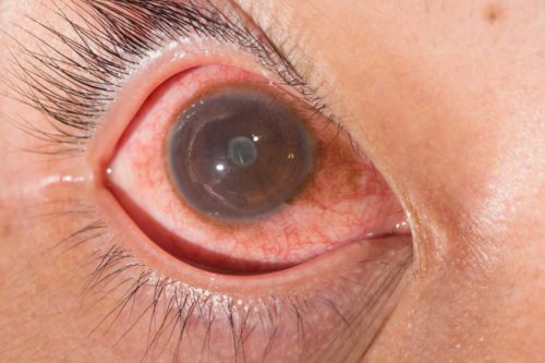 Uveitis: Gejala, Penyebab, Dan Cara Mengobati - DokterSehat