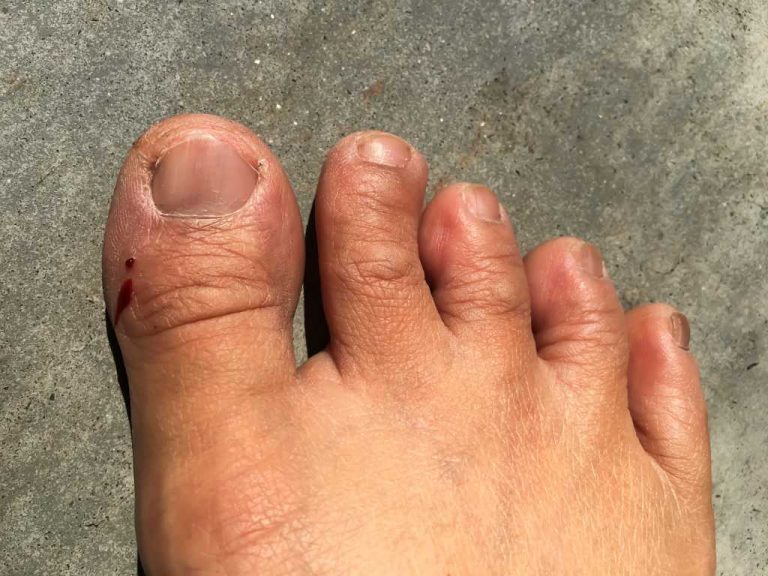 Gangren Penyebab Gejala Diagnosis Pengobatan gangren-penyebab-gejala-diagnosis-pengobatan