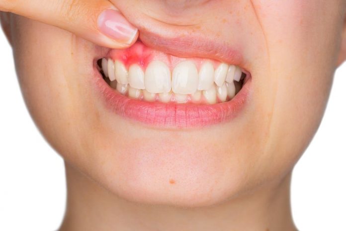 gejala-gingivitis-doktersehat