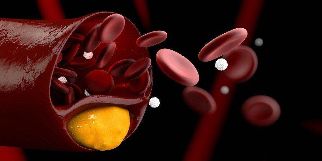 Hiperkolesterolemia: Penyebab, Gejala, dan Pengobatan