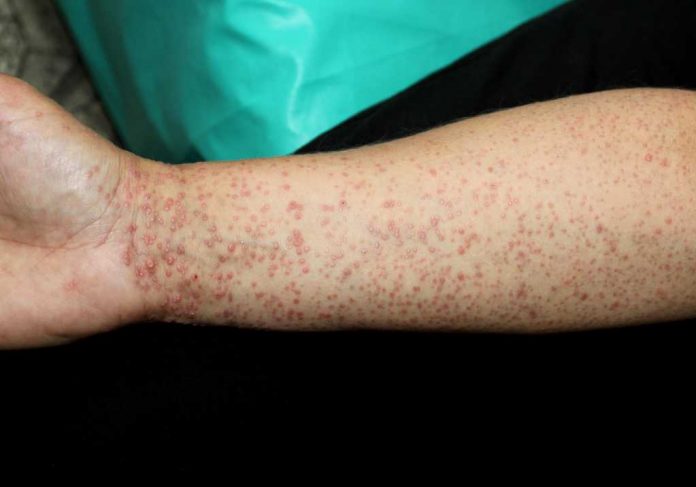 lichen-planus-doktersehat lichen-planus-doktersehat
