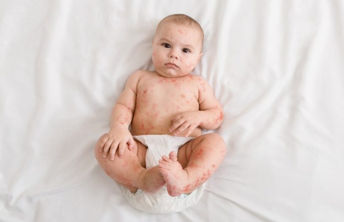 pengobatan-penyakit-kulit-pada-bayi-doktersehat