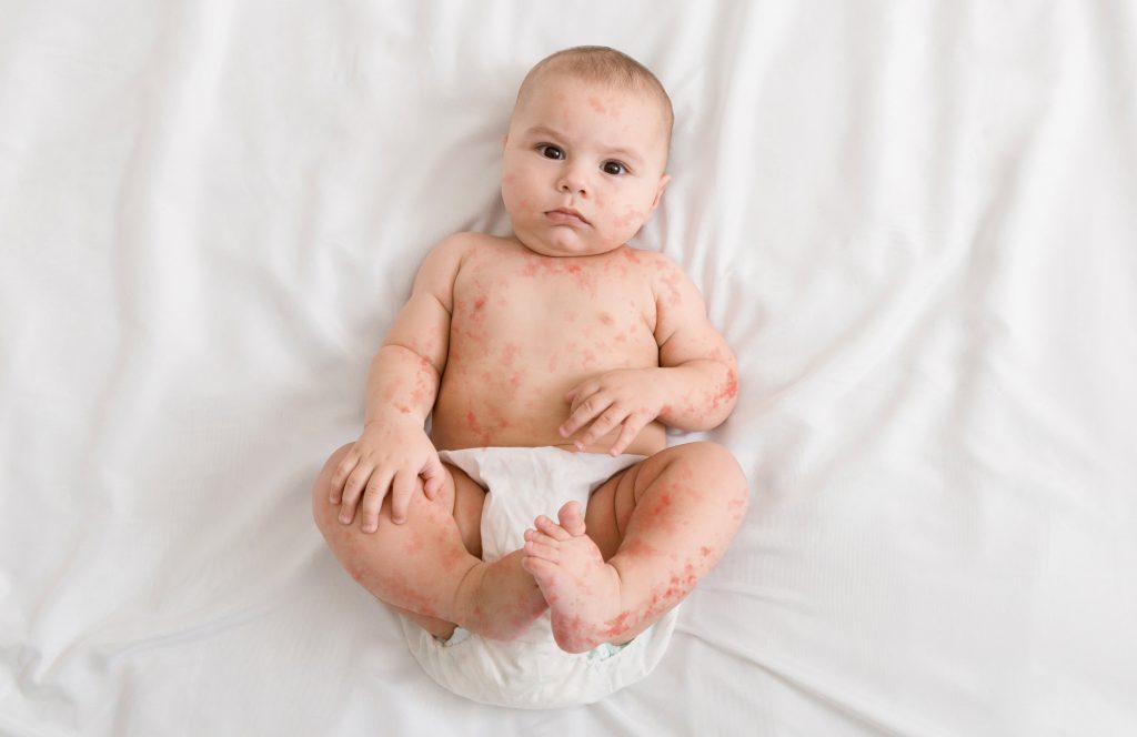 10 Penyakit Kulit pada Bayi yang Sering Terjadi (Dilengkapi Pengobatan)