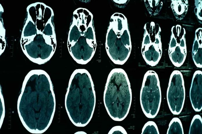 diagnosis-epidural-hematoma-doktersehat