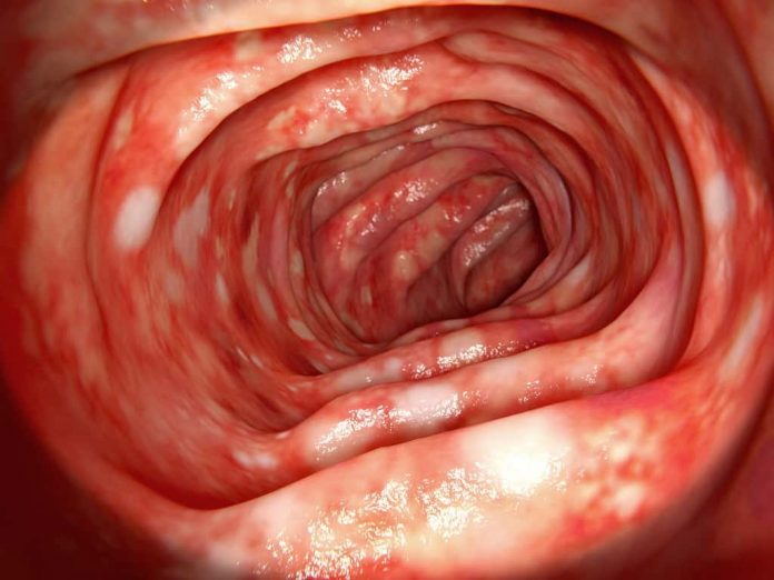 ulcerative-colitis-doktersehat
