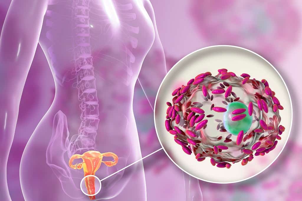 Vaginosis Bakterialis: Penyebab, Gejala, dan Pengobatan