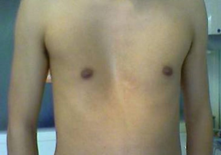 Pectus Excavatum (Dada Cekung) Gejala, Penyebab, dan Penanganan