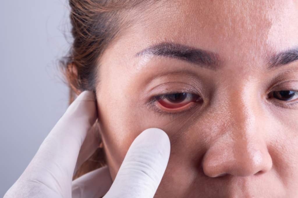 Glaukoma: Penyebab, Gejala, Diagnosis, Pengobatan, & Pencegahan