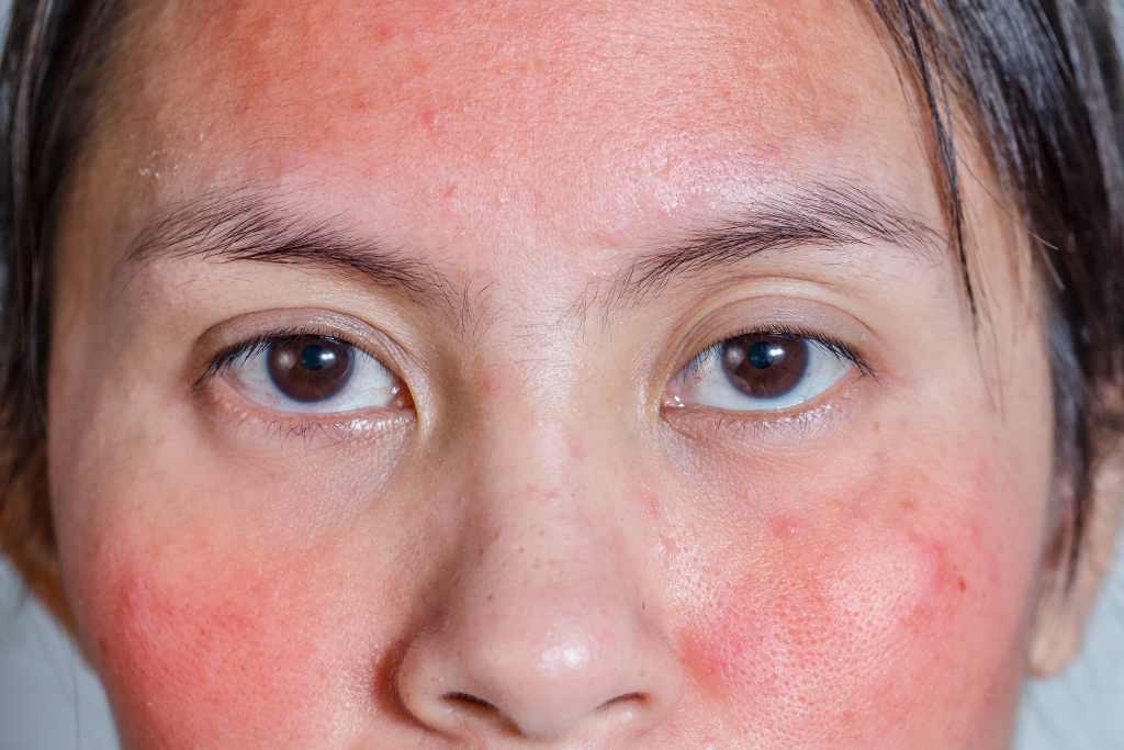 12 Penyebab Muka Merah yang Paling Umum Terjadi