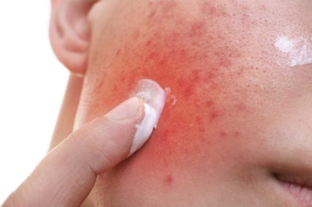 Azelaic Acid: Fungsi, Dosis, Efek Samping, Aturan Pakai, dll