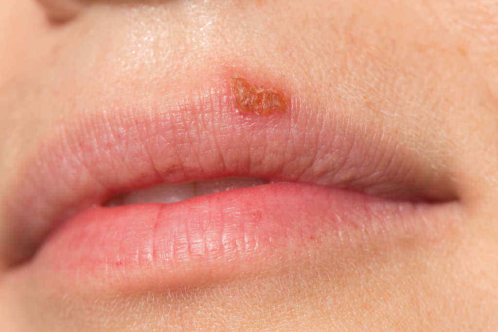 Herpes di Bibir (Herpes Oral): Penyebab, Ciri-Ciri, Cara Mengobati