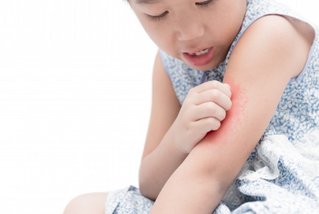 Alergi Gigitan Nyamuk dan Penangannya yang Tepat