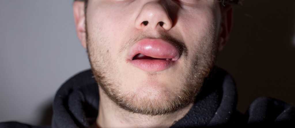 8 Penyebab Bibir Bengkak & Cara Mengatasinya