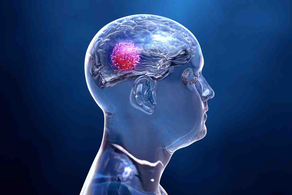 Kanker Otak: Gejala, Penyebab, Diagnosis, dan Pengobatan