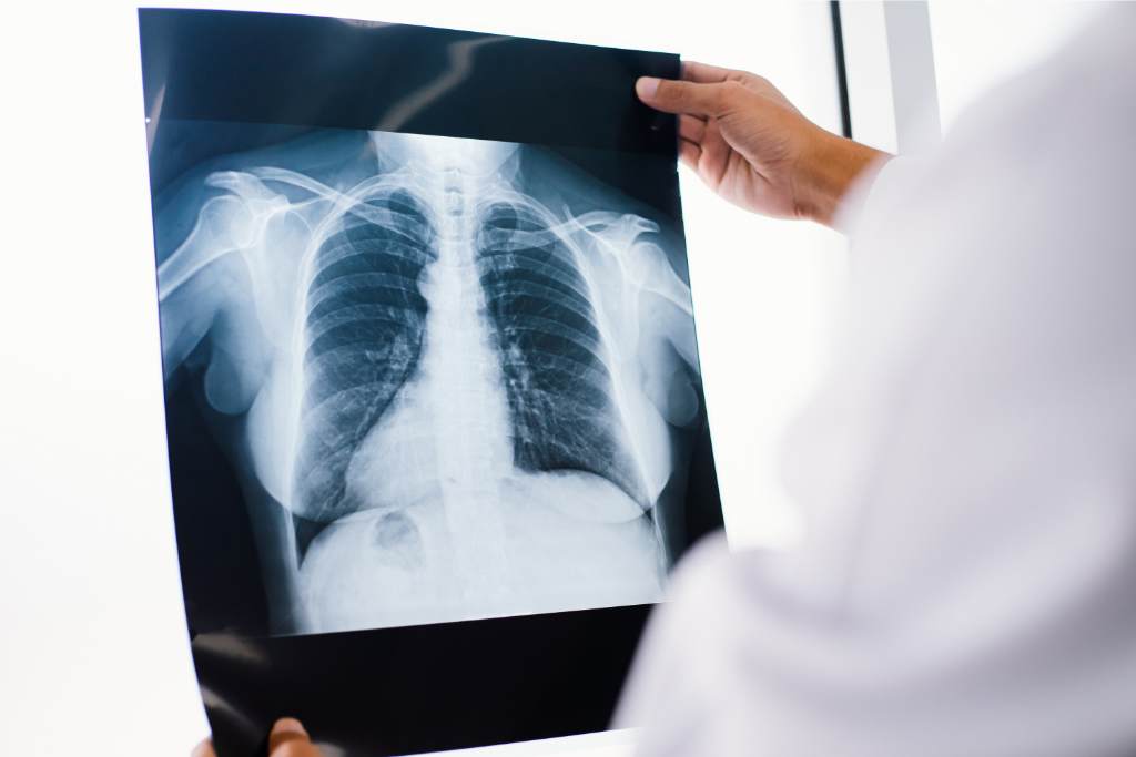 Mesothelioma: Gejala, Penyebab, Diagnosis, dan Pengobatan