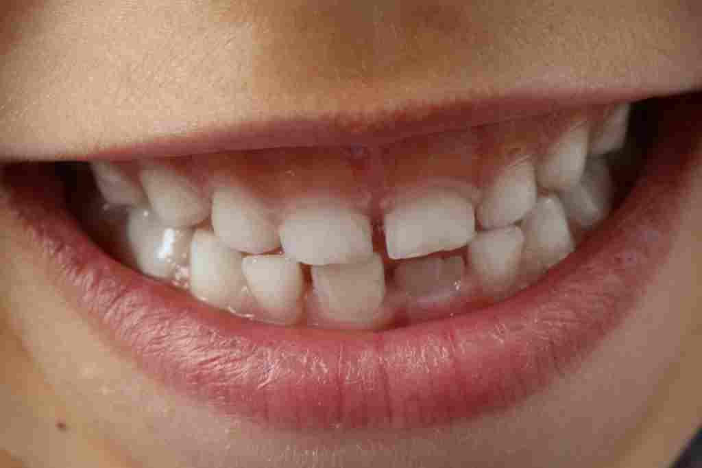 Dental Bridge: Fungsi, Jenis, dan Biaya