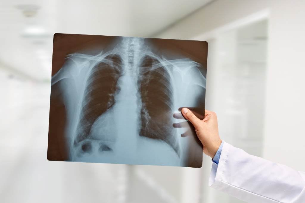 Beragam Jenis Pemeriksaan untuk Mendeteksi Kanker Paru-paru