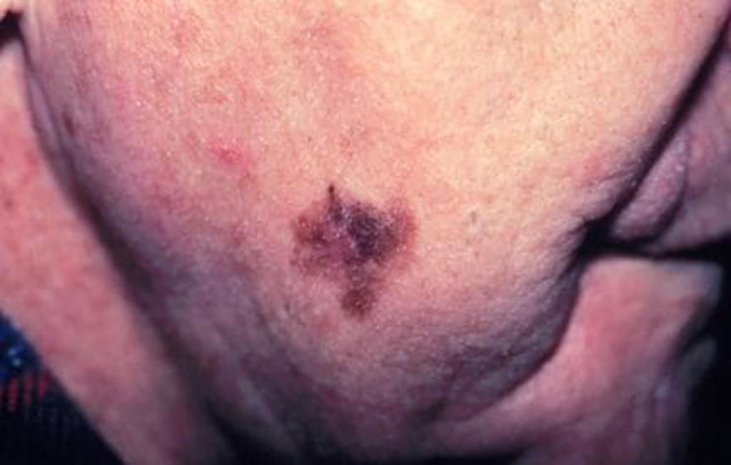 gambar melanoma pada kulit