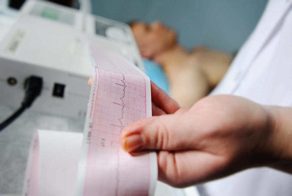 Elektrokardiogram (EKG): Indikasi, Tata Laksana, Biaya, dll