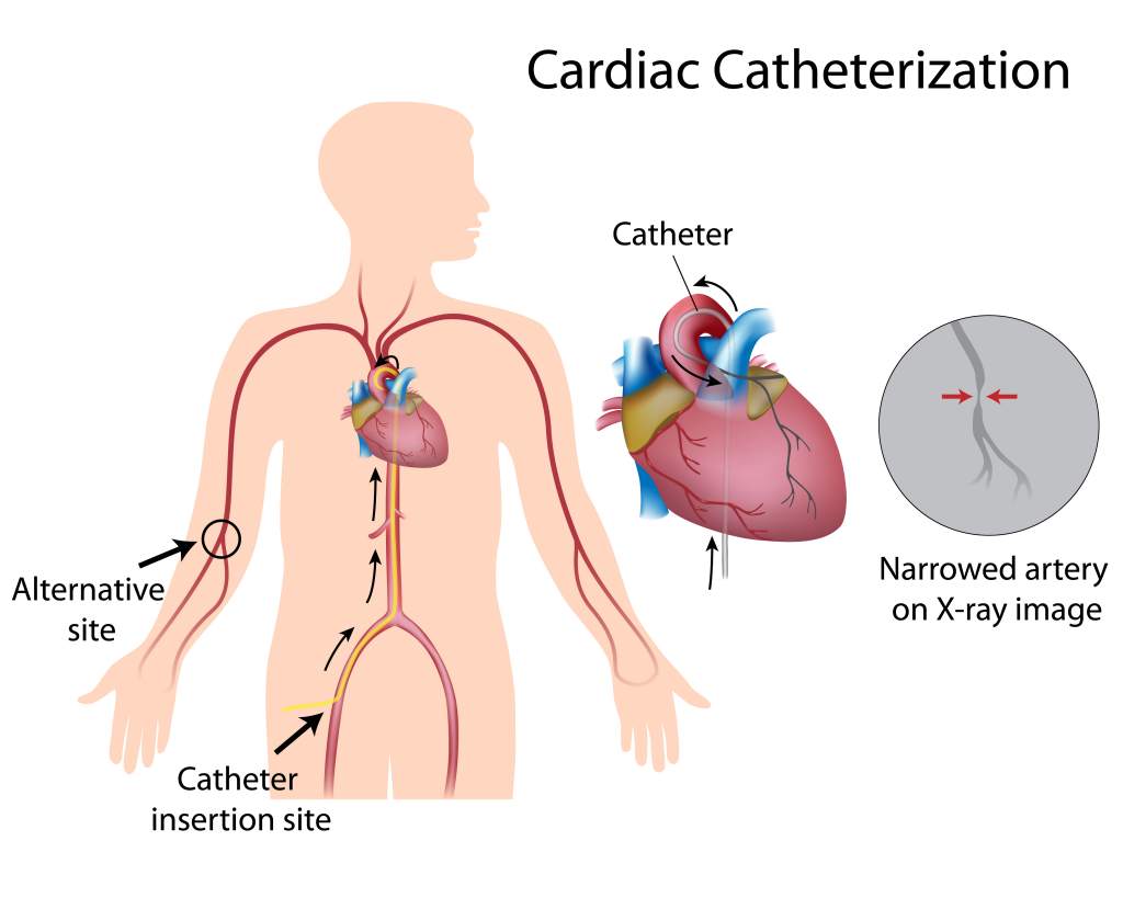 Kateterisasi Jantung: Fungsi, Persiapan, Prosedur, dan Risiko
