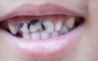 11 Cara Menghilangkan Gigi Hitam yang Efektif, Mudah Dilakukan