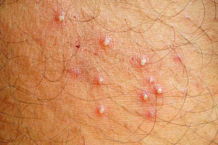 Folikulitis: Gejala, Penyebab, Cara Mengobati, dll - DokterSehat