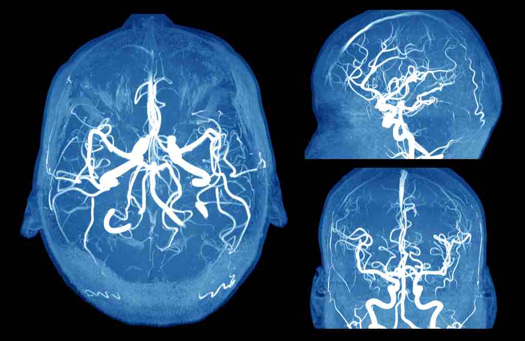 Aneurisma Otak: Gejala, Penyebab, Diagnosis, dan Pengobatan