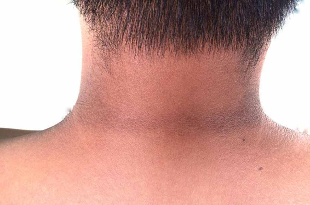 cara menghilangkan hitam di leher doktersehat