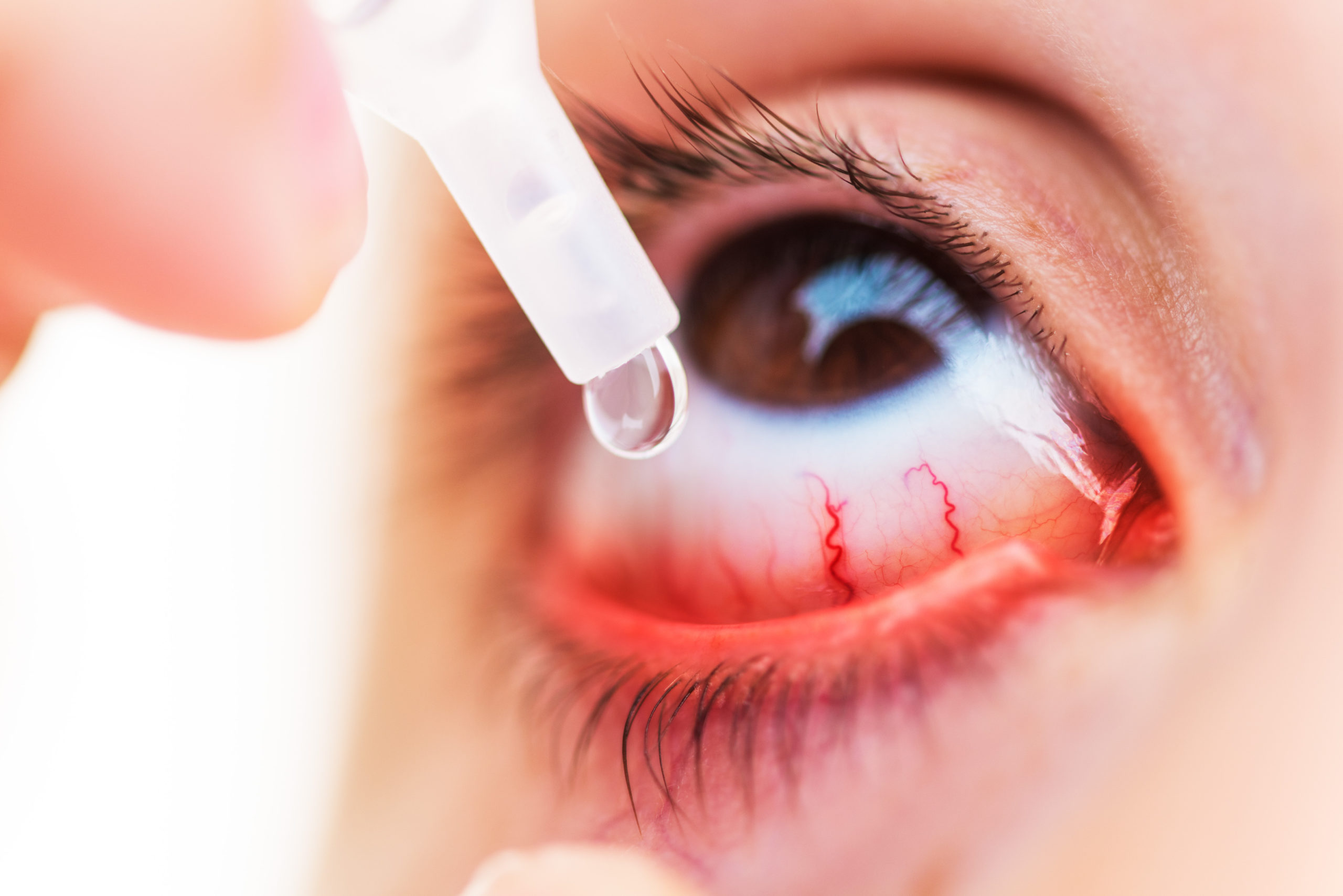 12 Obat Mata Merah yang Ampuh (Medis dan Alami) - DokterSehat