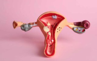 Kanker Endometrium: Gejala, Penyebab, Diagnosis, dan Pengobatan