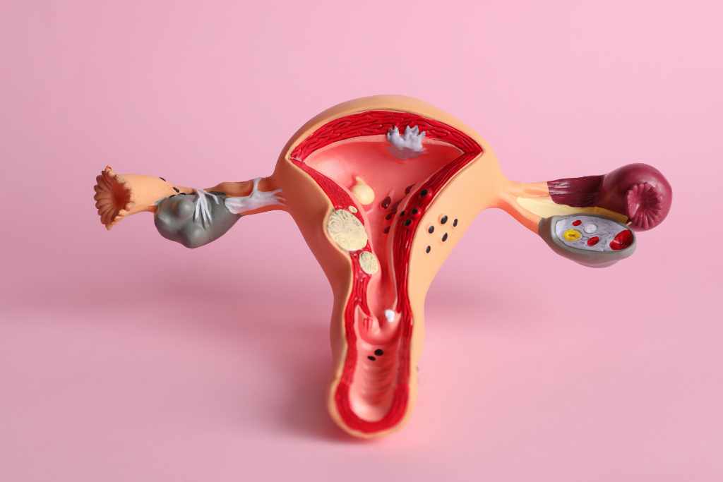 gambar kanker endometrium doktersehat