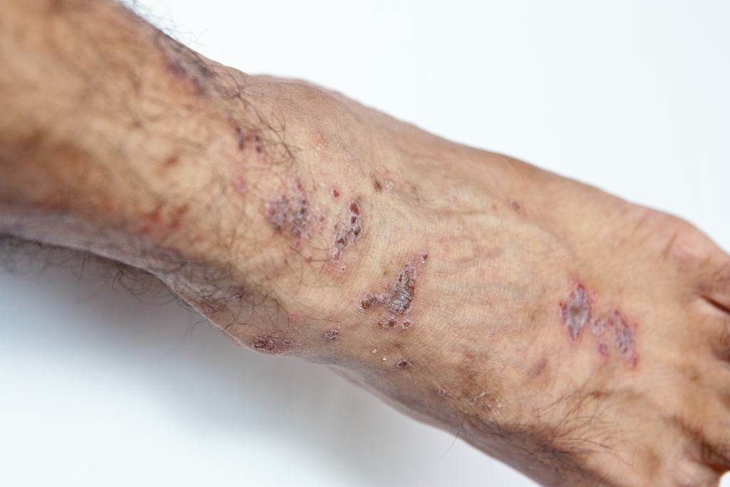 Dermatitis Stasis: Gejala, Penyebab, Cara Mengobati, Pencegahan, dll