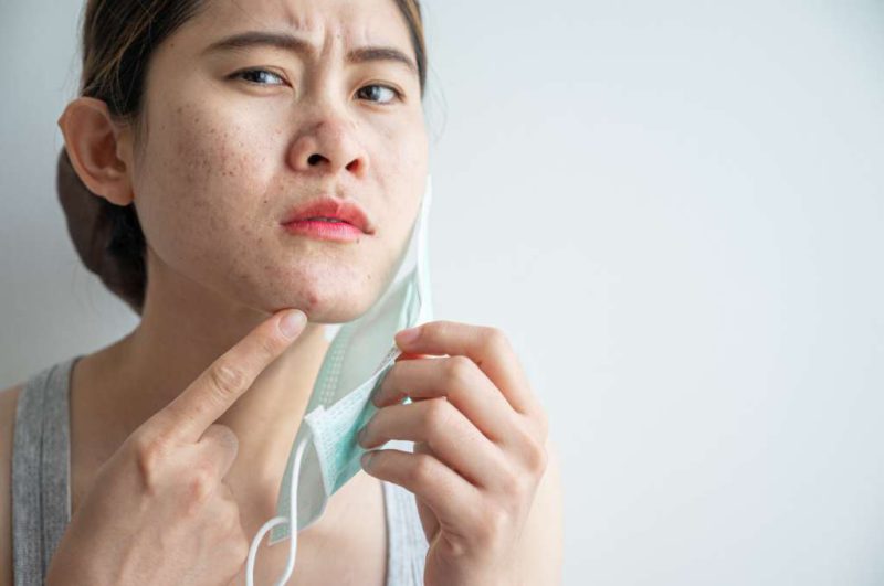 Maskne (Jerawat Akibat Masker): Gejala, Penyebab, dan Cara  