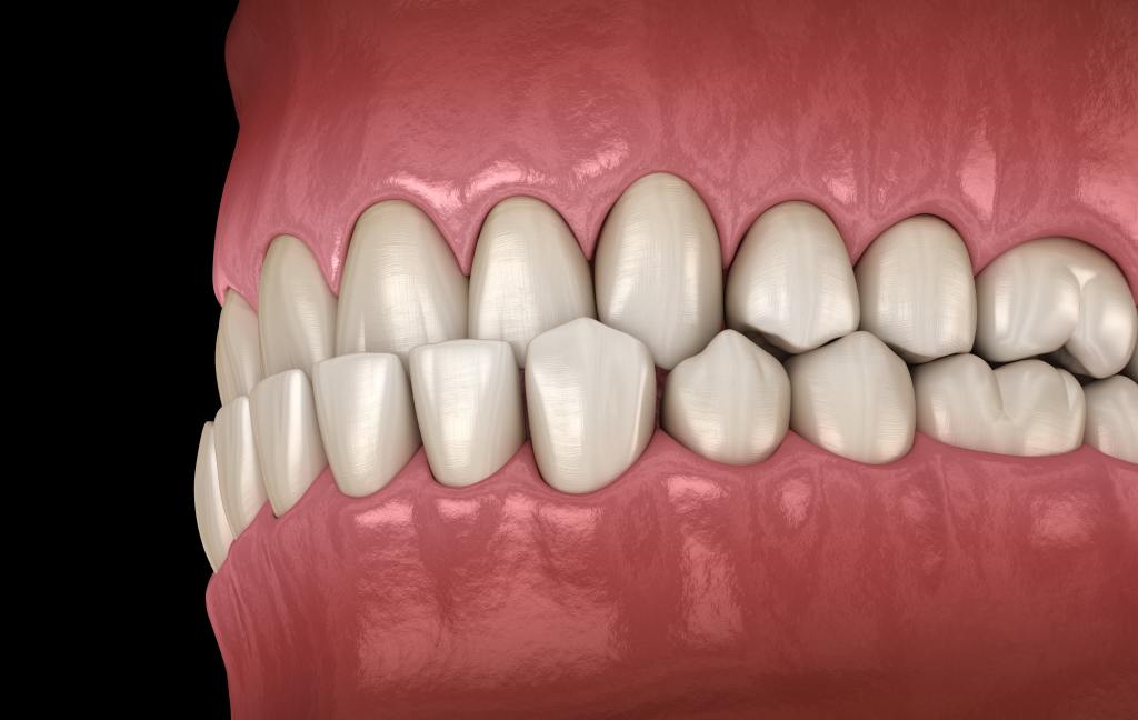 susunan gigi orang dewasa pada rahang adalah