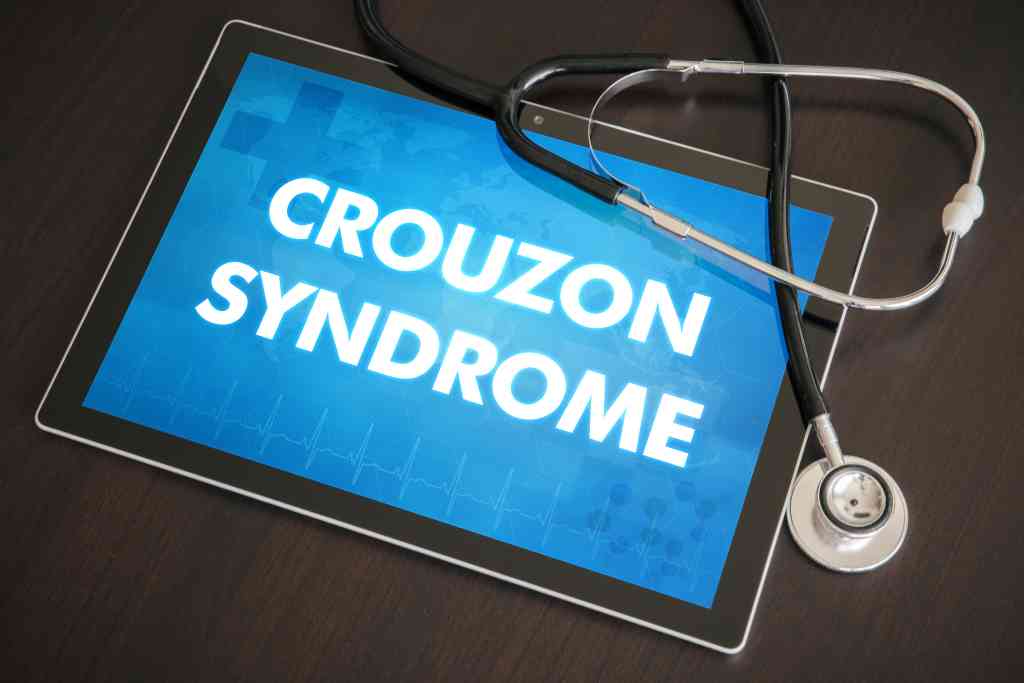 Crouzon Syndrome: Gejala, Penyebab, Diagnosis, dan Pengobatan