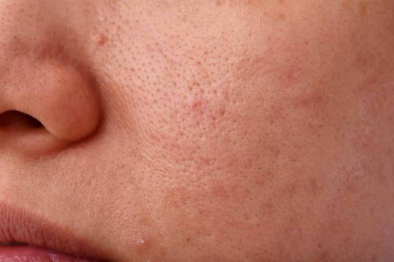 Blackhead Komedo Hitam Penyebab Dan 15 Cara Menghilangkannya 3634