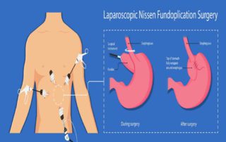 Fundoplikasi: Fungsi, Prosedur, Efek Samping, Biaya, dll