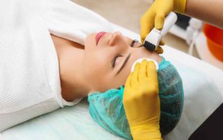 Microneedling: Manfaat, Efek Samping, Prosedur, dll