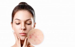 13 Skincare untuk Fungal Acne Paling Efektif