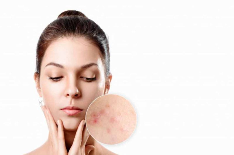 13 Skincare Untuk Fungal Acne Paling Efektif - DokterSehat