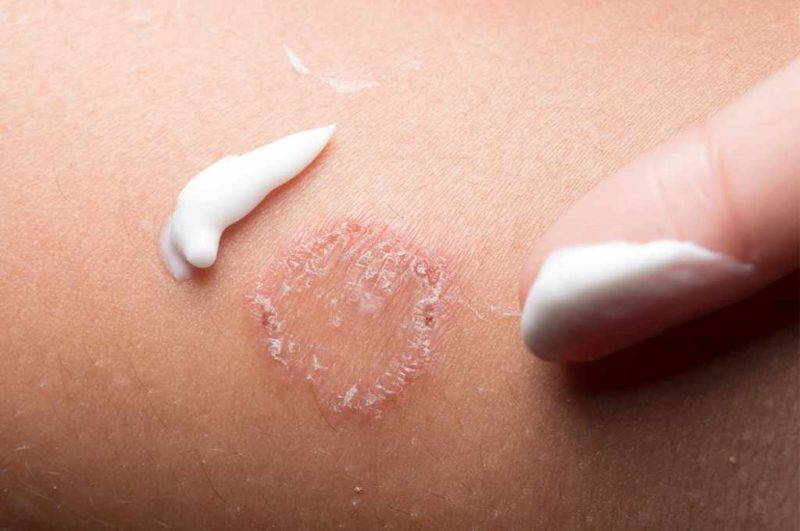 Tinea Corporis Kurap Badan Gejala Penyebab Cara Mengatasi Dll