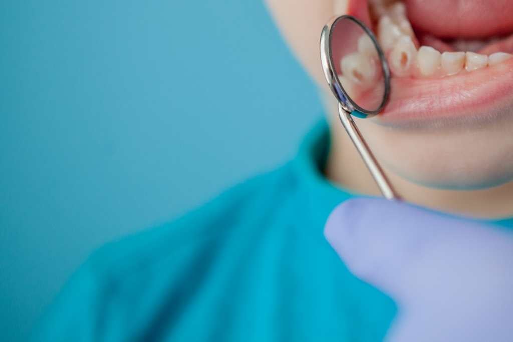 Kaitan Antara Kuman Gigi dan Kesehatan Tubuh