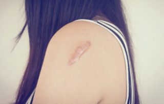 12 Cara Menghilangkan Keloid yang Efektif (Alami dan Medis)