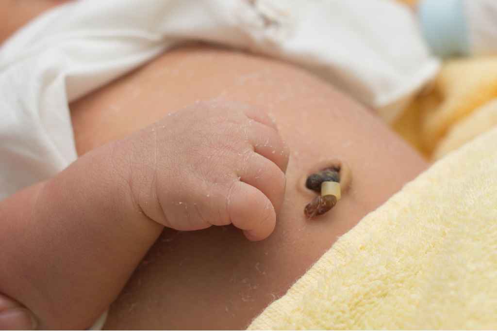 7 Cara Merawat Tali Pusar pada Bayi Baru Lahir agar Cepat Kering