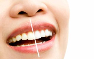 7 Cara Mengatasi Gigi Kuning Secara Alami (Mudah Dilakukan)
