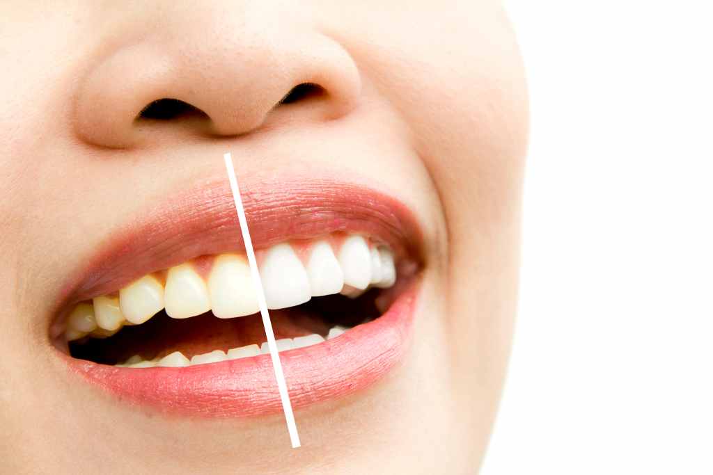 7 Cara Mengatasi Gigi Kuning Secara Alami (Mudah Dilakukan)